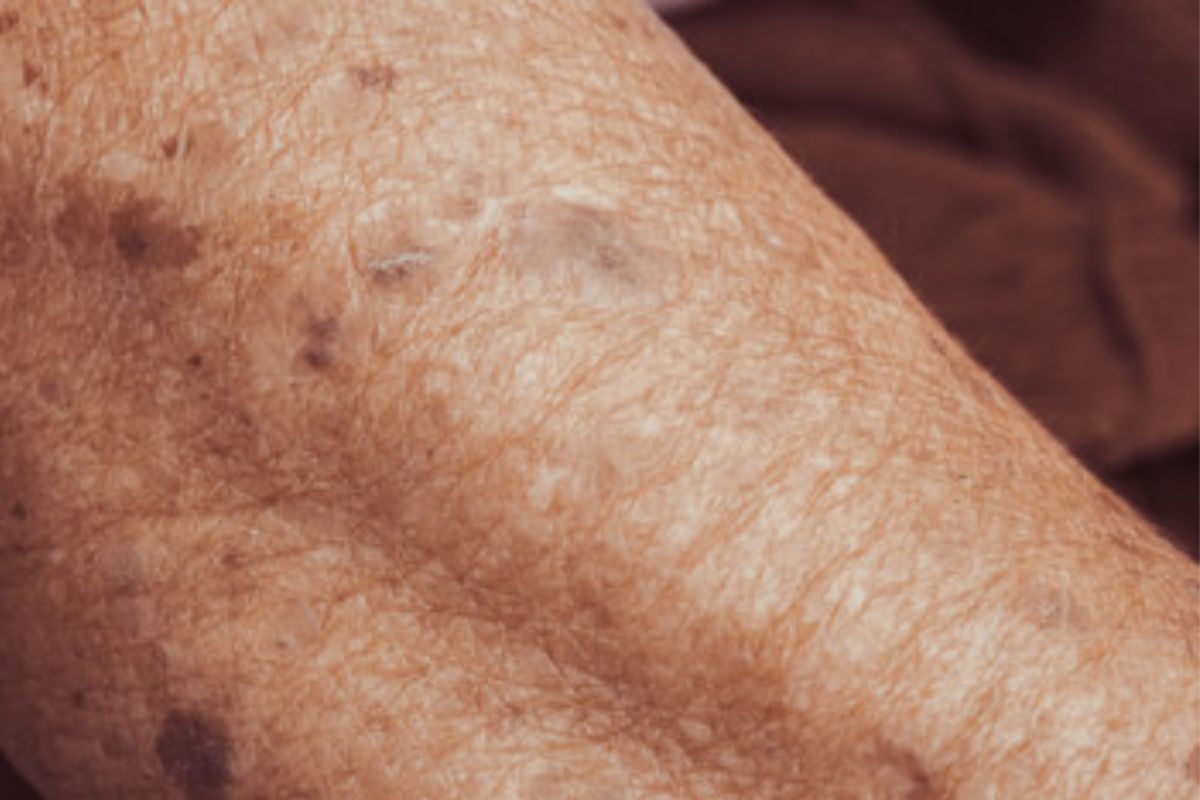 Idosos e Cuidados com a Pele: Como Evitar Lesões e Irritações com Simples Prevenções