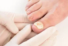 Unha do pé com micose visível sendo examinada por profissional com luvas.