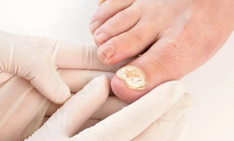 Unha do pé com micose visÃvel sendo examinada por profissional com luvas.