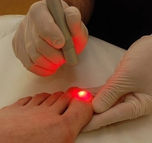 Laser aplicado em unha do pé para tratamento antifúngico