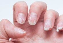 Unhas descamando e quebradiças por falta de cuidados e hidratação