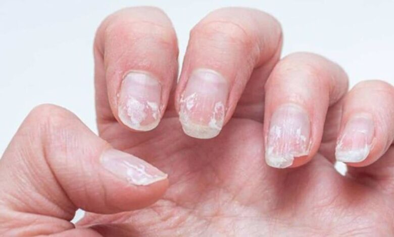 Unhas descamando e quebradiças por falta de cuidados e hidratação