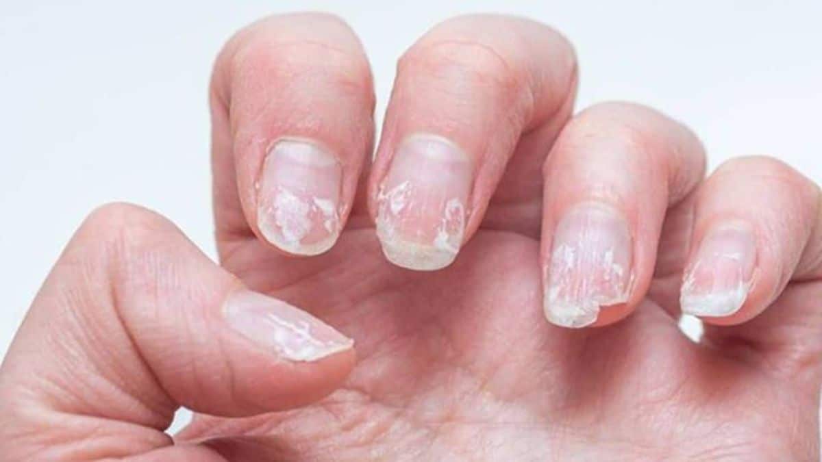 Unhas descamando e quebradiças por falta de cuidados e hidratação