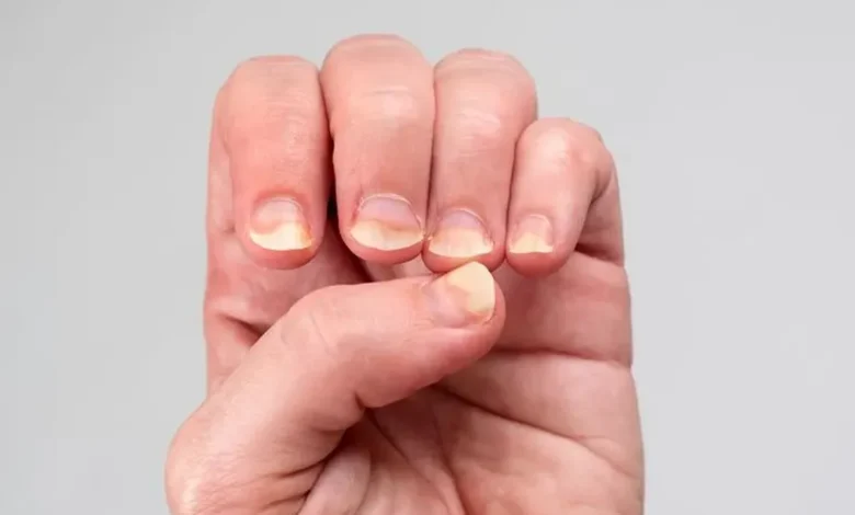 Unhas amareladas e manchadas, mostrando o problema de descoloração nas unhas