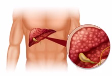 Imagem de um fígado com a vesícula biliar, ilustrando a anatomia relacionada à dor na vesícula e opções de cirurgia.