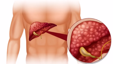 Imagem de um fígado com a vesícula biliar, ilustrando a anatomia relacionada à dor na vesícula e opções de cirurgia.