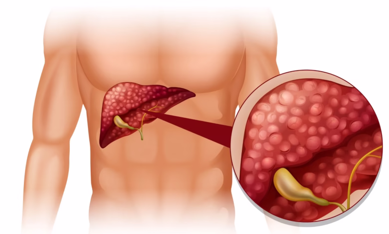 Imagem de um fígado com a vesícula biliar, ilustrando a anatomia relacionada à dor na vesícula e opções de cirurgia.