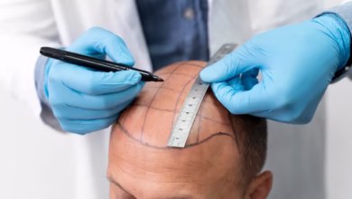Profissional marcando áreas do couro cabeludo para transplante capilar masculino