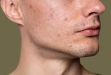 Imagem de um rosto com foliculite, mostrando lesões e acne visíveis na região da mandíbula e pescoço.