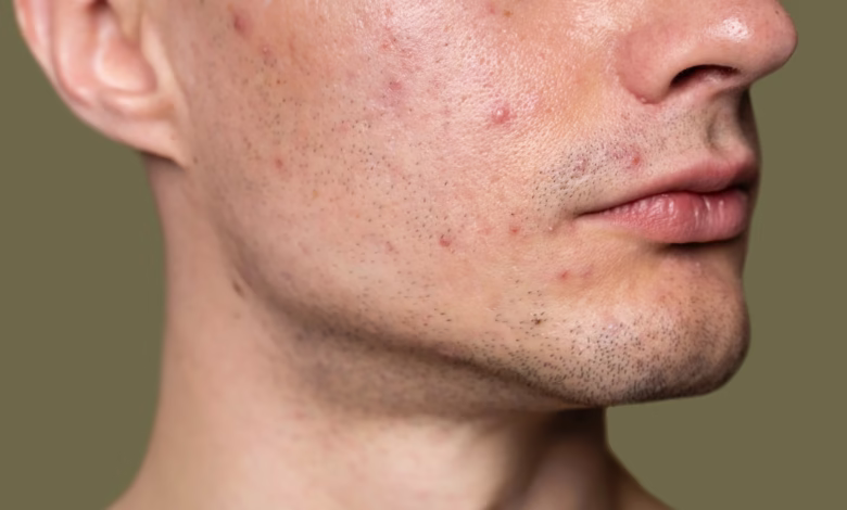 Imagem de um rosto com foliculite, mostrando lesões e acne visíveis na região da mandíbula e pescoço.