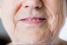 Close-up da boca de uma pessoa idosa, destacando o ressecamento da pele ao redor dos lábios e a gengiva, como um sinal de alerta para o diabetes.